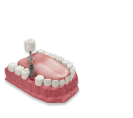 Подберем имплант под Ваш бюджет