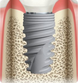 Зубные импланты Nobel Biocare