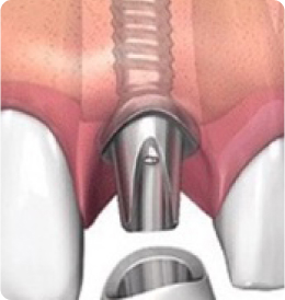 Зубные импланты Alpha Bio