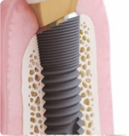 Зубные импланты Astra Tech