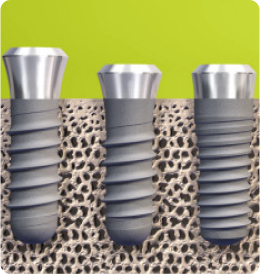 Зубные импланты Strauman