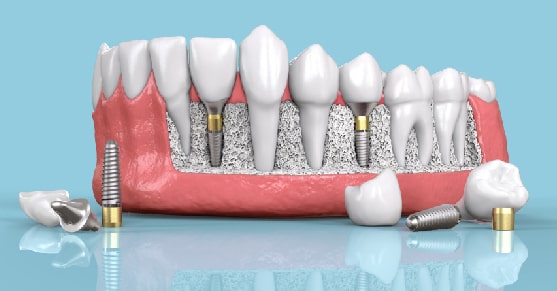 Что такое циркониевые коронки?