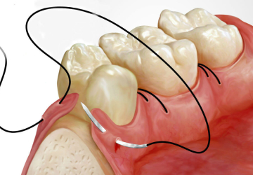 Прогрессирующий пародонтоз