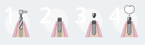 Отсутствие всех или почти всех зубов