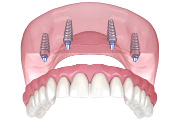 Протезирование all-on-4 верхней челюсти