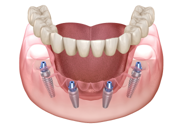 Протезирование all-on-4 верхней челюсти