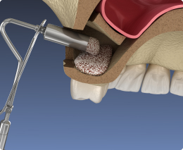 Отказ от проведения синус-лифтинга