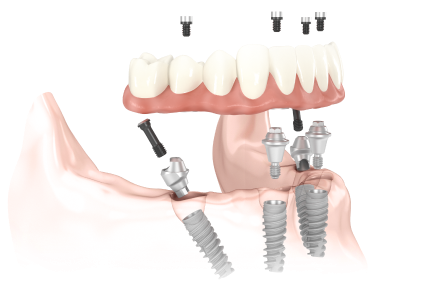 All-on-4 в Москве: имплантация зубов за один день