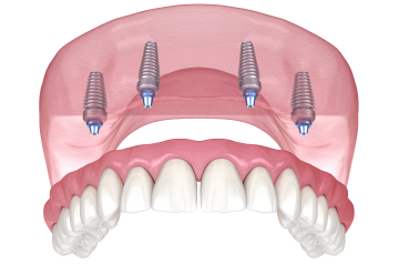 Протезирование all-on-4 верхней челюсти