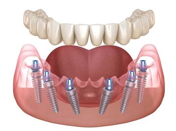 Протезирование all-on-4 верхней челюсти