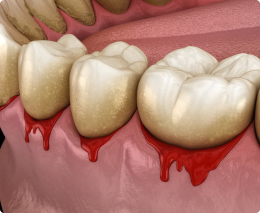 Прогрессирующий пародонтоз