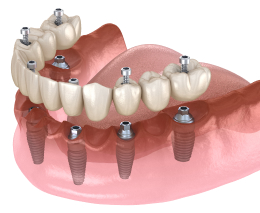 Отказ от проведения синус-лифтинга