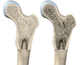 Отказ от проведения синус-лифтинга