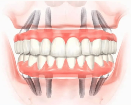 All-on-4 в Москве: имплантация зубов за один день