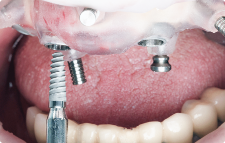 All-on-4 в Москве: имплантация зубов за один день